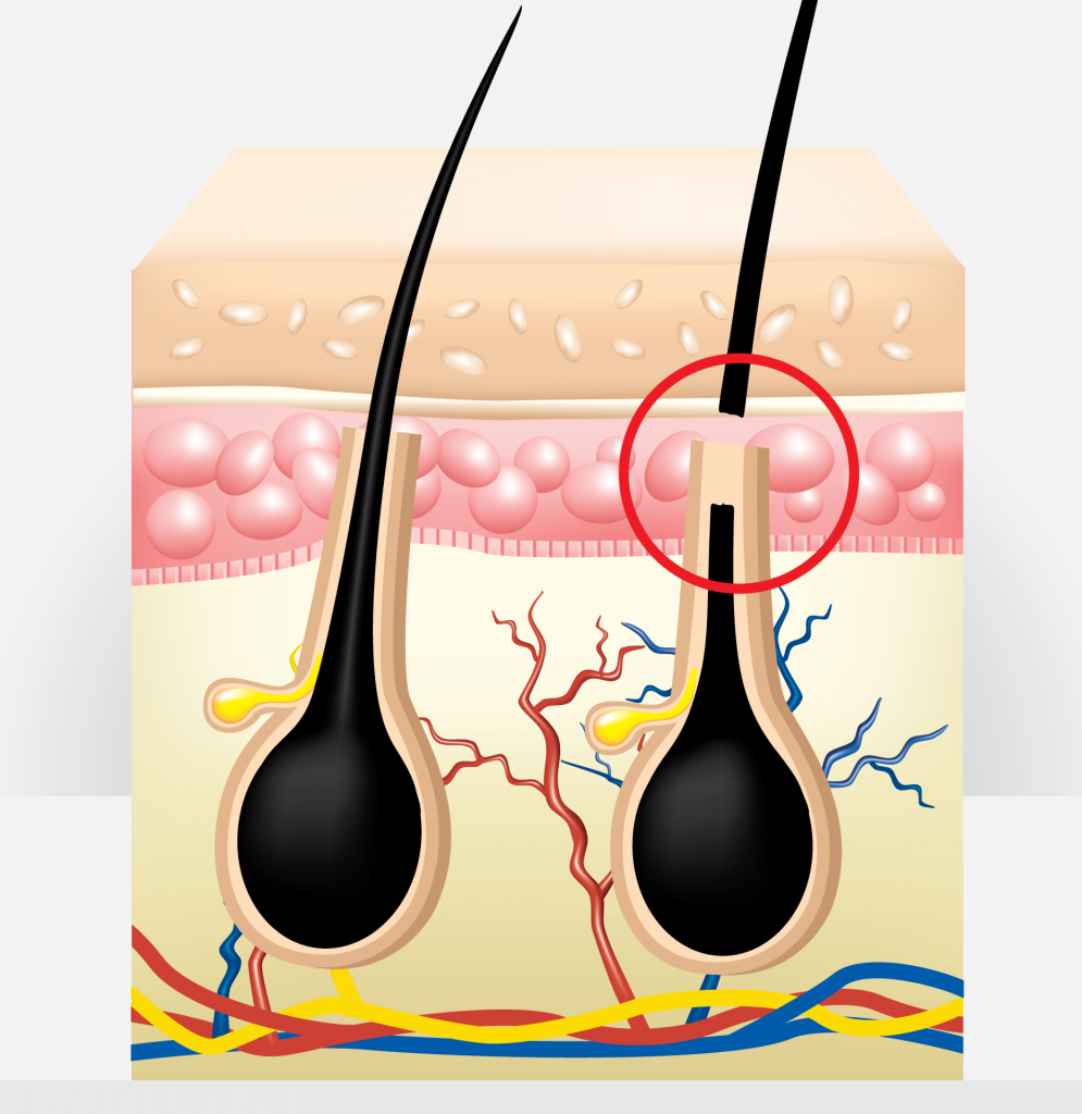 épilation laser